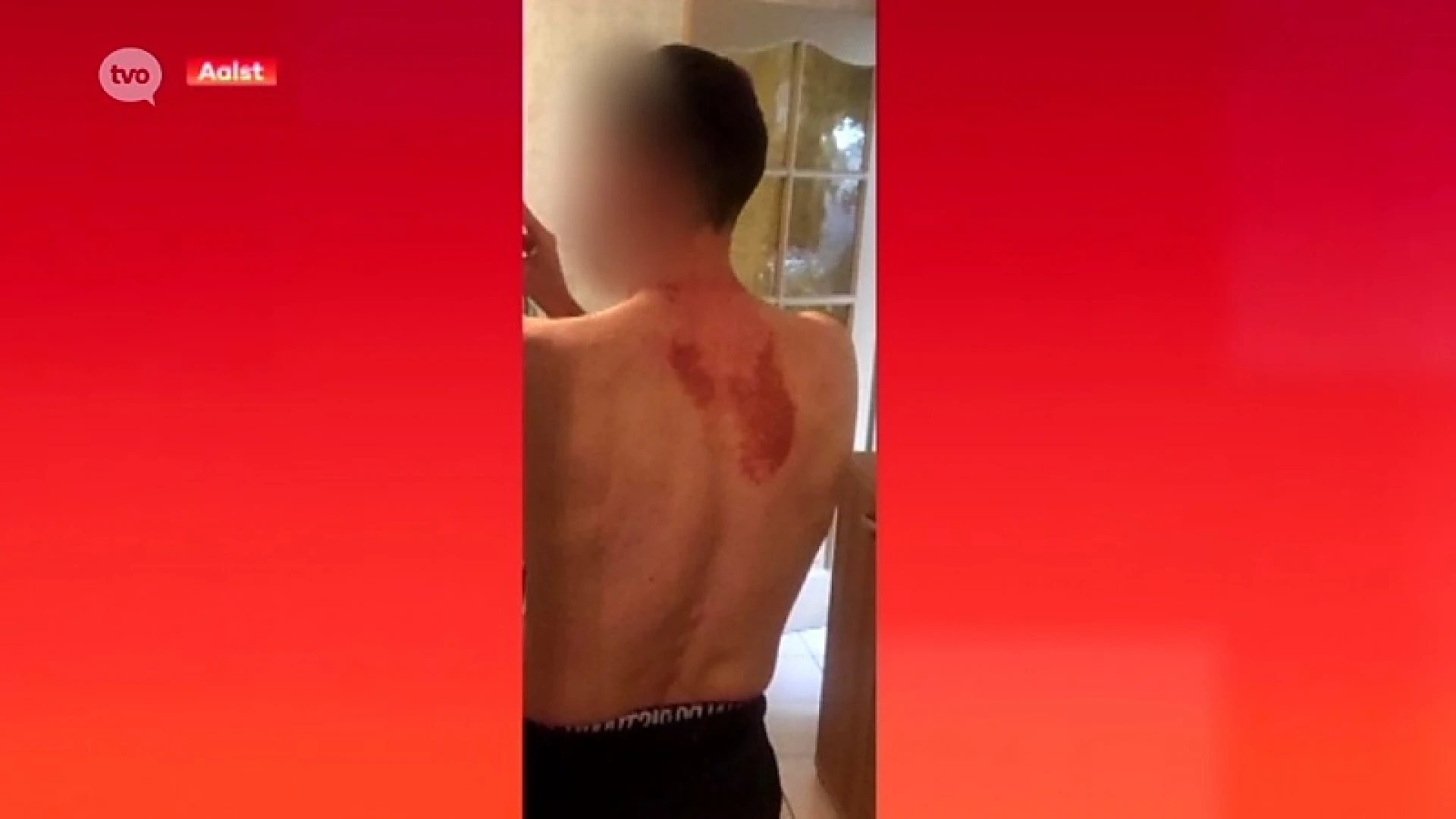 Carnavalist verbrand nadat hij bijtende vloeistof in nek krijgt gegoten